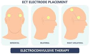 Extracted ECT source-deck visual