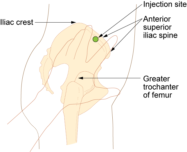 Extracted IM injection landmarking visual